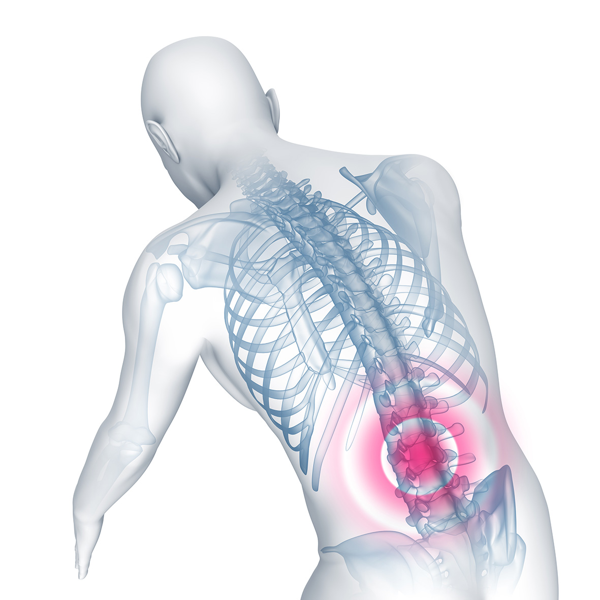 Rückenschmerzen - Rücken mit Röntgenbild